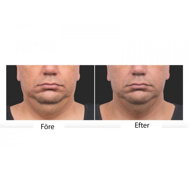 Före & efter Coolsculpting behandling av ansiktet