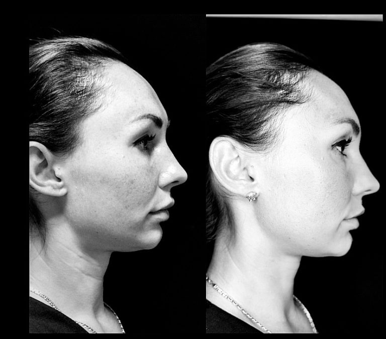 Resultat Trådlyft: mellan/ nedre delen av ansiktet